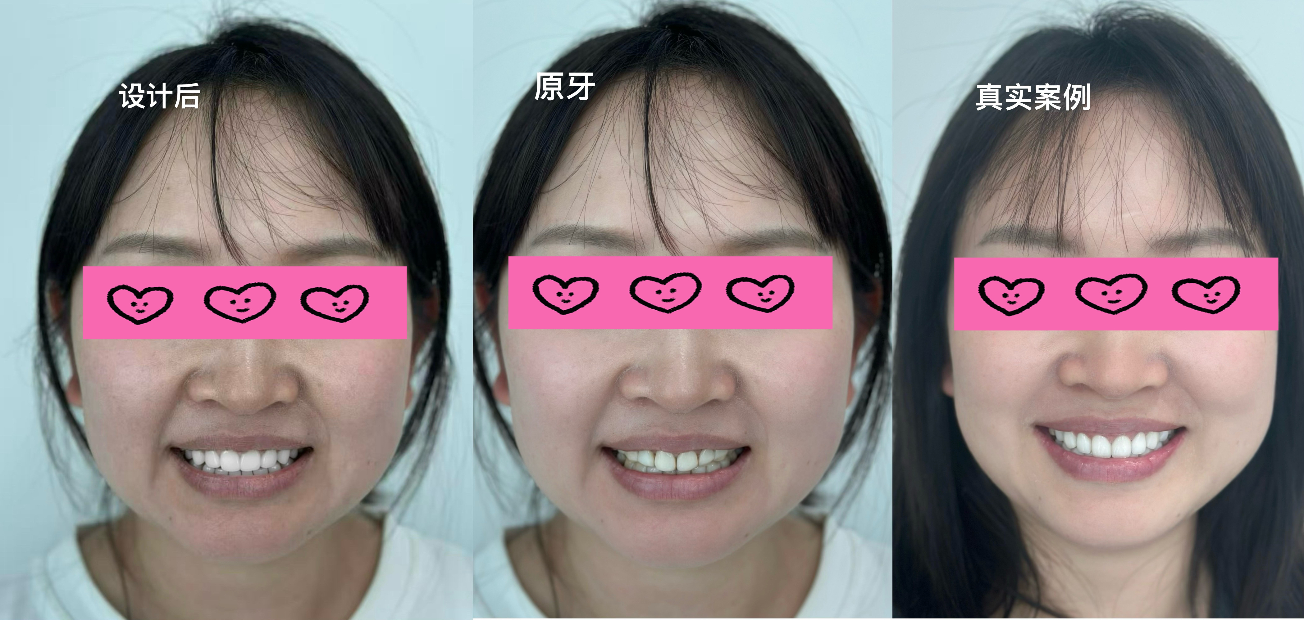 深圳牙齒美容案例素材 107
