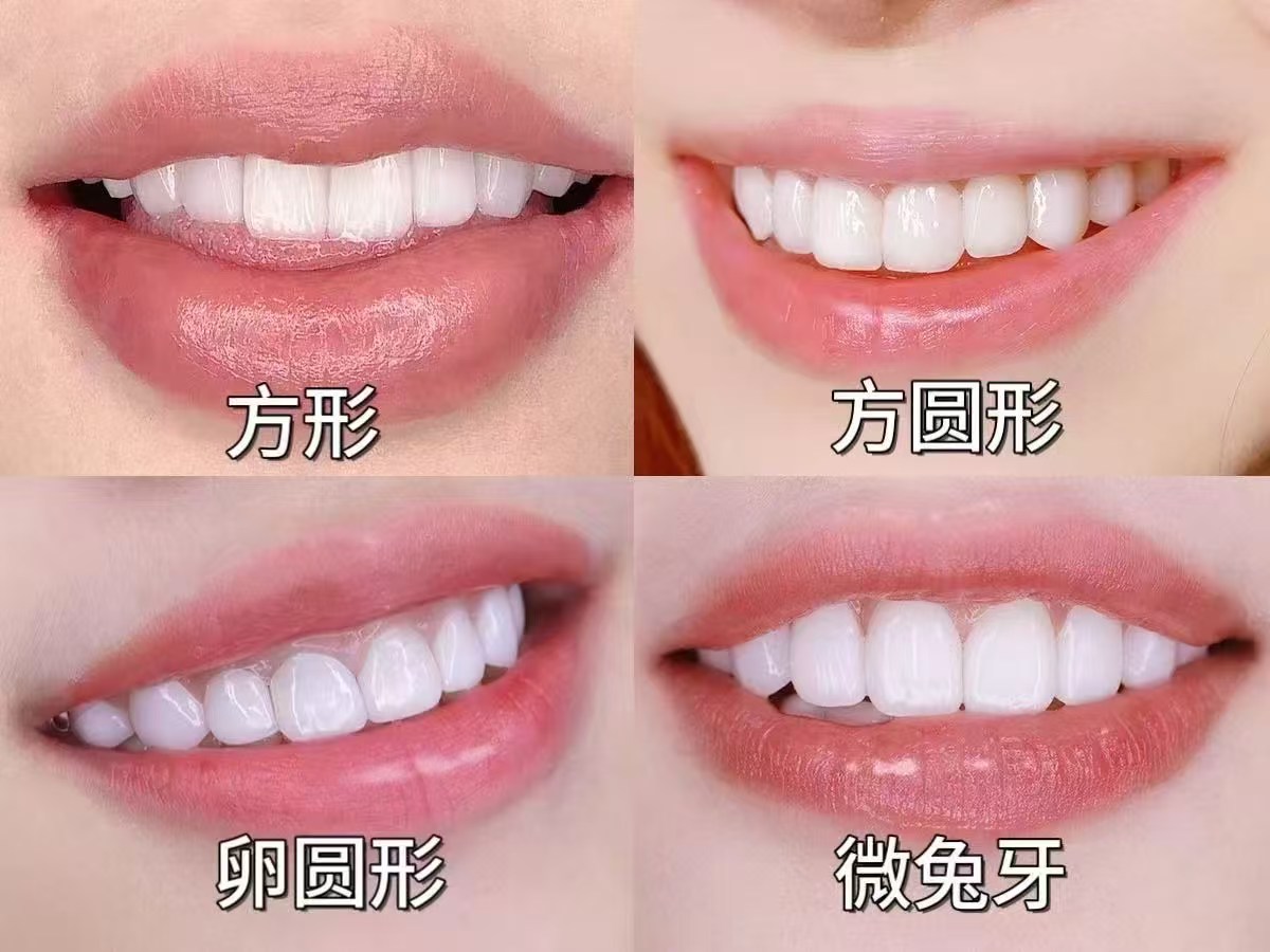 星辰皓齒牙齒美容案例素材 124